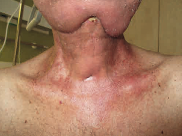 &copy; Strahlendermatitis Grad 1