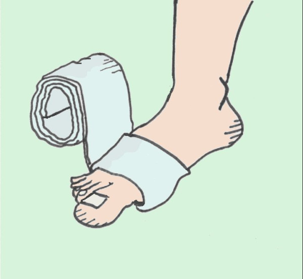 &copy; Jan Hinnerk Timm | Kompressionsbandagierungen immer unterpolstern. 